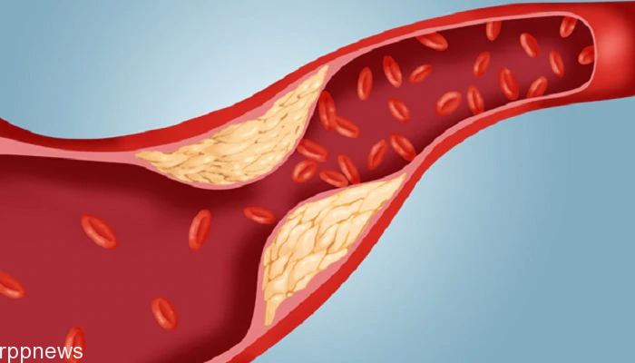 Although cholesterol is essential for the human body, it is very worrying that it is excessive; why is cholesterol rising? Find out the solution.