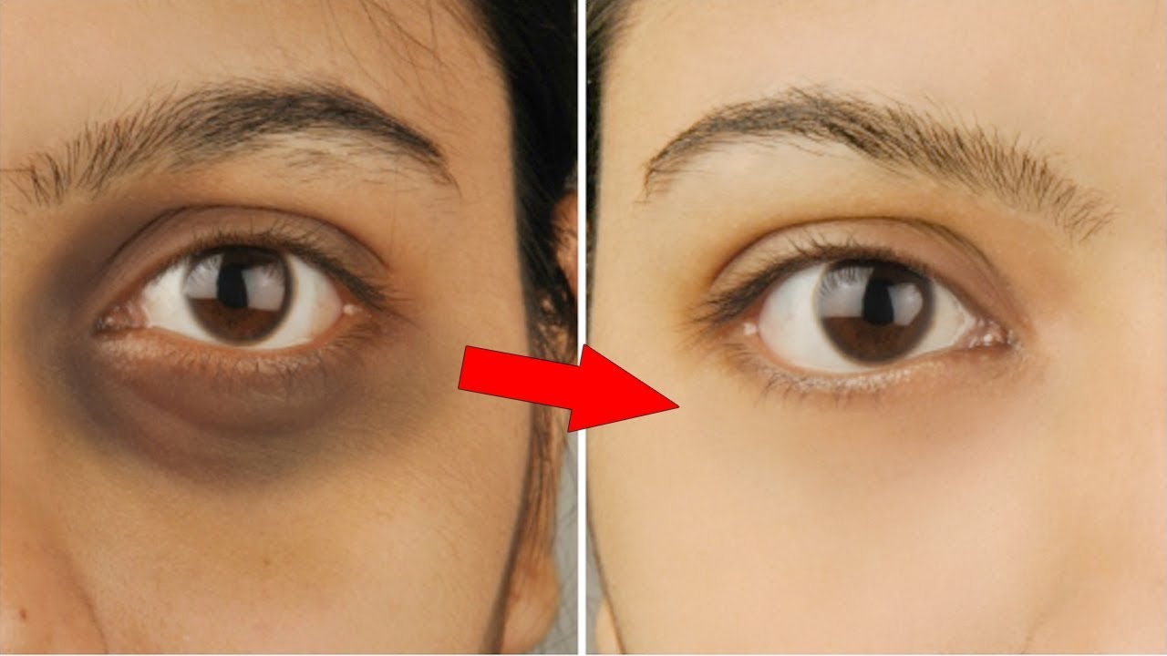 Find out how to get rid of dark circles under the eyes! Learn more, 5 home remedies to get rid of blackheads.